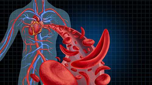 CBC Battles Sickle Cell Related Blindness